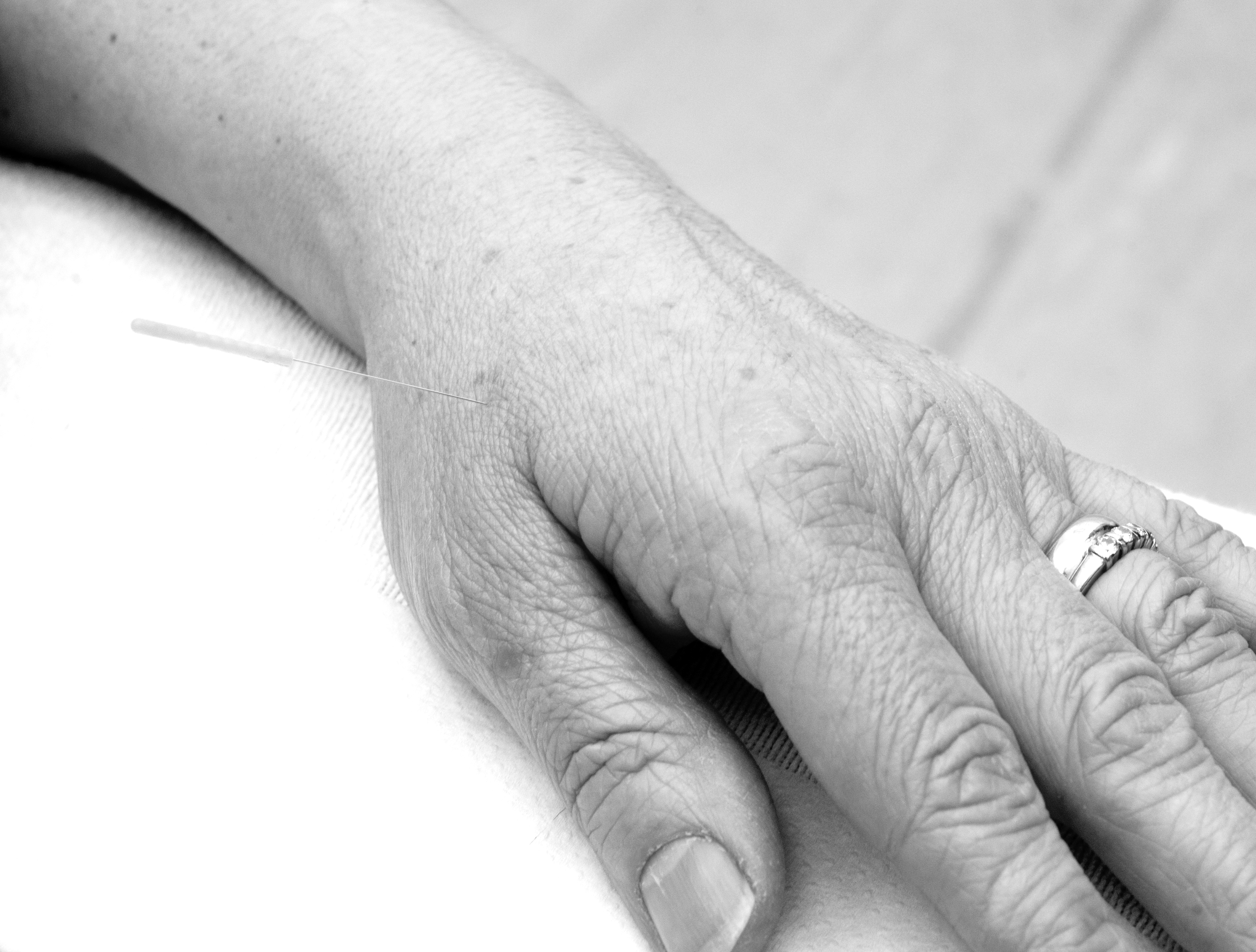 Hands trying out acupuncture